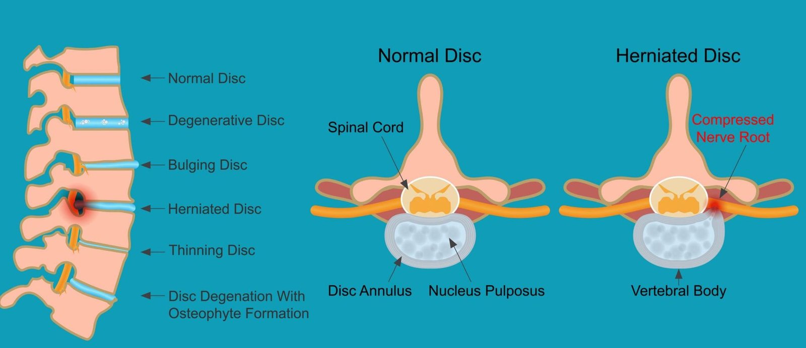 Herniated disc with the sciatic nerve tethered
