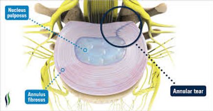 Annular tear