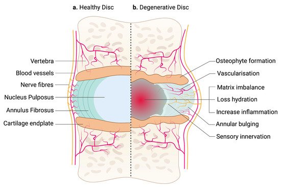 Healthy disc versus degenerative disc