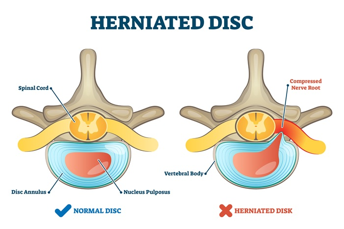 Herniated disc versus normal disc, nerve root compression
