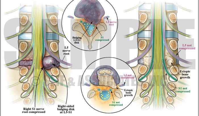 Patient with herniated disc