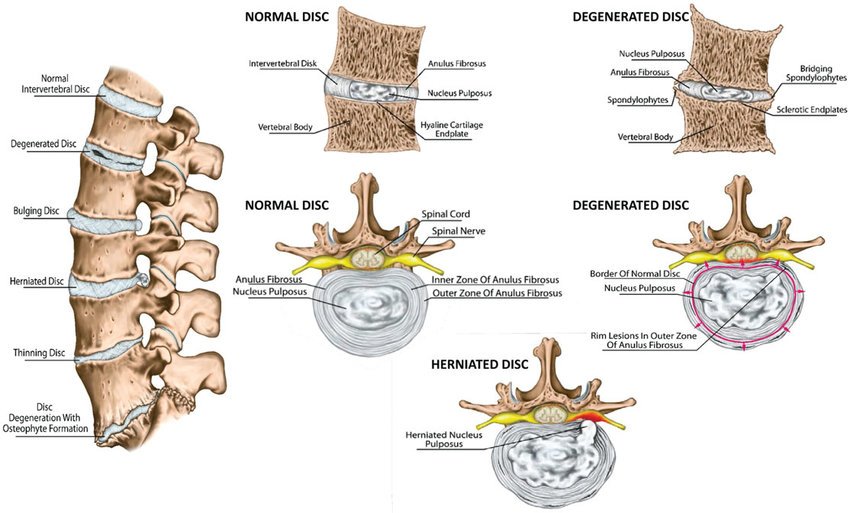Spine and intervertebral disc anatomy, healthy